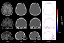 방사선 노출 많은 CT 안찍어도 된다? MRI로 CT 만드는 AI 기술 개발
