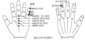 추석 연휴 때 과식하다가 생긴 급체… ‘수지침’으로 다스린다