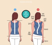 청소년기에 흔히 발생하는 척추측만증 …외형 변화로 정서적 고통 커