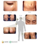 피부에 흰 반점 백반증 , 7~8월 발생 많아