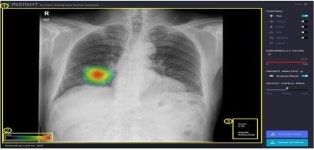 국내 업체 개발 AI 의료기기 2건 허가…AI가 폐결절 찾아내