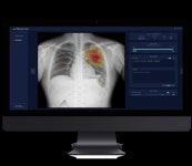 제이엘케이인스펙션, AI 폐질환 분석 솔루션 공급..코로나19 조기 진단