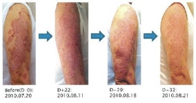 알앤엘바이오, 日건선환자 지방줄기세포로 효과 입증