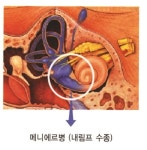 [Health in Life] 난청ㆍ이명ㆍ어지럼증 몰려온다면? 메이에르병 주의