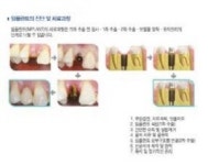 즐거운 치과의 건강한 치아 만들기, 씹는 즐거움 통해 제2의 인생사는 임플란트