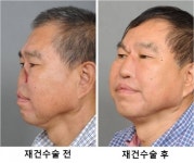 암수술로 코 잃은 중국인, 한국서 재건 성공