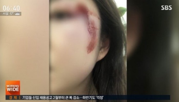 서울역 묻지마 폭행, 어깨 일부러 부딪힌 후 얼굴 가격→광대뼈 골절…네티즌 '분노' | 포토뉴스