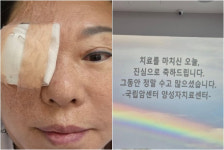양희은, 각막이식에 이어 방사선치료도 마무리⋯