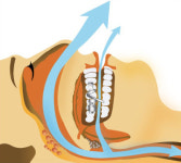 코골이 수면무호흡증 치료 방법