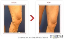 혈액의 역류가 일어나서 늘어난 혈관이 보이는 하지정맥류 예방법은?