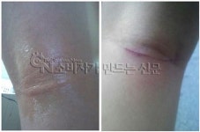 [포토]제일약품 한방 파스 붙였더니 ‘살점도 같이 떼가