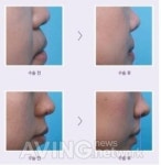 뼈를 깎지 않는 안면윤곽술? 고양이수술