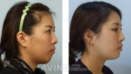 [미리보는 의료관광전시회 2012] M치과의원, 내외국인 대상으로 턱성형 수술 홍보 예정