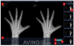 (주)뷰노 뷰노메드 본에이지, 국내에서 개발한 인공지능(AI) 기반 의료기기 첫 허가