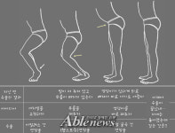 뇌성마비에 대한 의사들의 생각③
