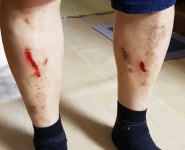 시각장애인 지하철 승강장 발빠짐 사고 노출