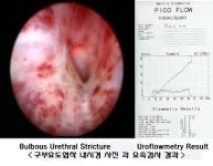 요도협착, 홀뮴레이저I(Holmium Laser)로 치료 가능