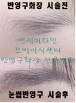 이제는 눈썹 반영구화장대신에 모발이식으로 자연눈썹이식이 대세