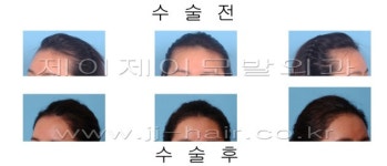 [모발이식]헤어라인 교정을 통해 올 봄 유행하게 될 헤어스타일을 당당하게 연출해 보자!