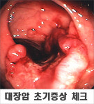 전문의에게 알아본 대장암의 치료와 예방