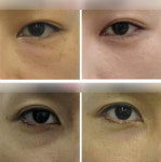 [이종승 원장의 예뻐지는 성형 이야기⑤] 눈밑 성형으로 아름다운 눈매 만들기!