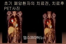 로봇사이버나이프 암치료 효과 탁월