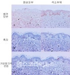 굵은 털난 반점 ‘베커모반’, 남성호르몬과 관계있다