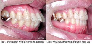 장기 치아교정 꼭 주치의를 두어라