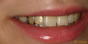 지르코니아를 이용한 심미 치료