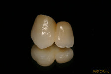 지르코니아를 이용한 심미 치료