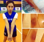 보라, 배구 연습 때문에 시퍼렇게 멍든 두 팔 “나 아팠어”