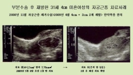 여성건강 위협하는 자궁근종, 한약으로 잡아준다