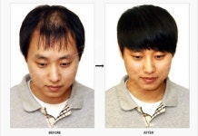 크레이지드레드(CrazyDread) 세계상 대표 탈모 스트레스를 붙임머리, 증모로 날려버리세요