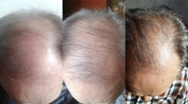 한방으로 탈모의 근원 치료하는 ‘평강 머리나’