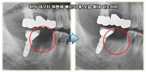 애물단지 사랑니, 복덩이로 변신