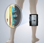 정맥혈전색전증(VTE) 예방을 위해 개발된 휴대용 모바일 압박기기  VENOWAVE 효과 평가