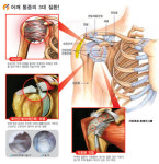 관절내시경을 이용한 어깨 치료