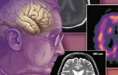 영화 내 머리 속의 지우개를 통해 본 치매