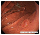 위 유암 (carcinoid 종양) 내시경으로 보면 이런 모양 입니다