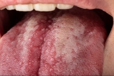 가벼운 구내염인 줄 알고 병원 갔는데…헐 구강암이라고?