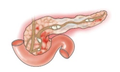 [양기영의 췌담도암 진-료-후] 급성췌장염, 만성췌장염 그리고 췌장암