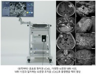 디지털 조직진단장비로 수술 중 실시간 뇌종양 진단 가능