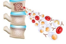 재발 잦은 다발골수종에 새 치료옵션 등장…엘렉스피오 국내 허가