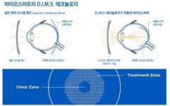 마이오스마트 iQ, 어린이 근시 진행 ZERO 시대 열어…글로벌 최초