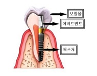 *임플란트 재료비 원가 많아야 14만원대