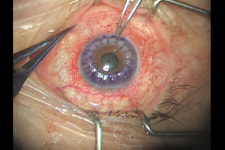 제주대병원, 제주 병원 최초 양안 동시 자가 각막이식수술 성공