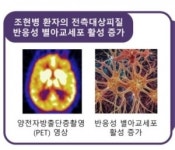 '별아교세포' 조현병 병리·생리 '관여' 