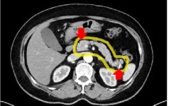 건협 부산센터, 복부조영CT를 포함한 췌장정밀 묶음형 검진 시행
