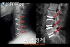 성베드로병원 척추크리닉 동양인 체형에 맞춘 인공디스크치환술