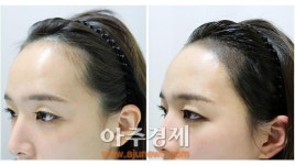 반영구 헤어라인문신, 첫인상 관리까지 가능